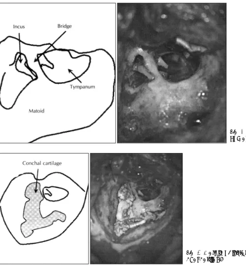 Fig. 4. Intact bridge tympa- tympa-nomastoidectomy. 