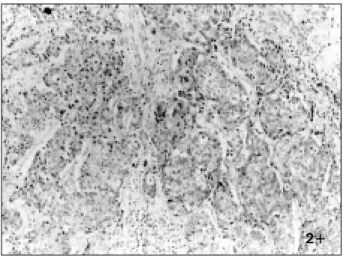 Fig.  1.  Breast  cancer  cells  with  a  negative  membraneous  staining  for  c-erbB-2,  ×400.