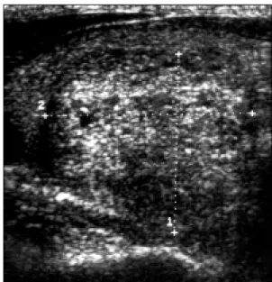 Fig.  1.  Simple  abdomen.  Ileus  change  of  small  bowel  at  central  portion  of  abdomen.