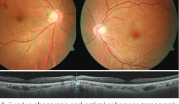 Figure 3. Fluorescein angiography at 8 months later shows new vit- vit-reous hemorrhage in the left eye