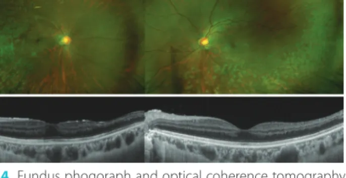 Figure 4. Fundus phogoraph and optical coherence tomography   (OCT) at 9 months. (A) Fundus photographs of both eyes show well  controlled vasculitis with photocoagulation scar