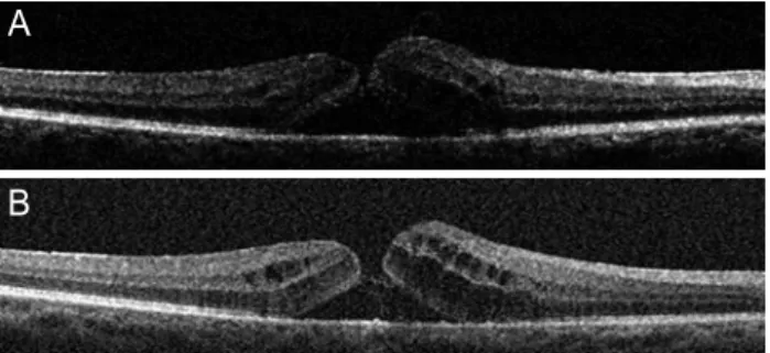 Figure 2. Optical coherence tomography image. One month after  the second partial vitrectomy with internal limiting membrane  peel-ing and gas tamponade, the macular hole was closed.