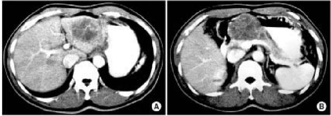 Fig.  2.  A  0.6  cm-sized  depressed  erosion  is  found  at  the  anterior  wall,  lesser  curvature  side  of  gastric  angle