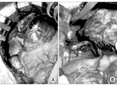 Fig.  4.  On  gross  finding,  this  mass  is  solid,  well  encapsulated  and  is  clearly  separated  from  the  stomach.