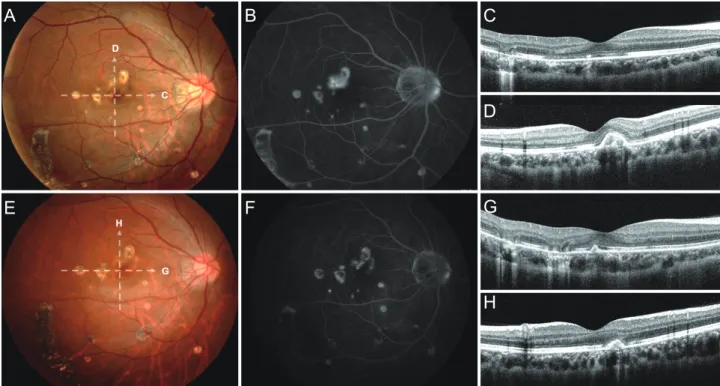 Figure 1. Representative case (Patient 5) of choroidal neovascularization (CNV) associated with multifocal choroiditis (MFC)