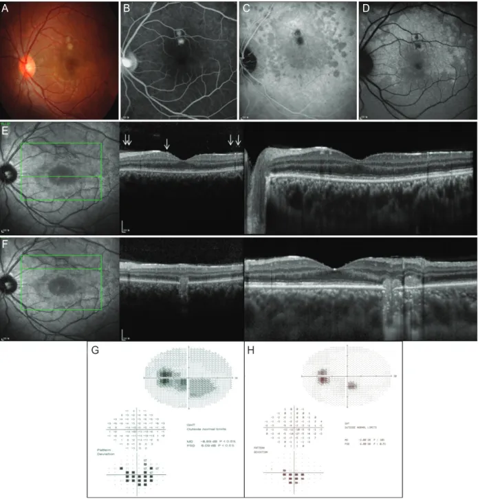 Figure 3. This 22-year-old man with myopia complained of central scotoma in the left eye right after suffering from upper respiratory infec- infec-tion