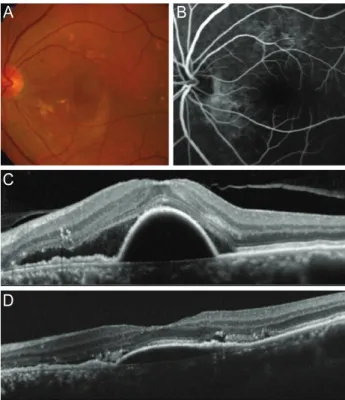Table 1. Characteristics of 15 included eyes (15 patients)
