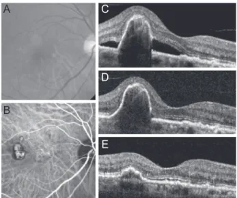 Figure 2. A representative case showing treatment outcome of  polypoidal choroidal vasculopathy