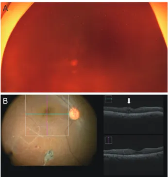 Table 3. Diagnosis of comorbid retinal disorder during vitrectomy  by iOCT 