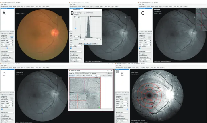 Figure 1. Measurement of preoperative and postoperative vascular shift in macular hole patients using custom software
