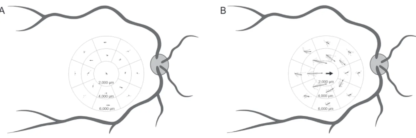Figure 2. Schematic drawings of the displacement of retinal vessels after surgical macular hole closure in the no-internal limiting membrane  peeling (ILMP) group and the ILMP group