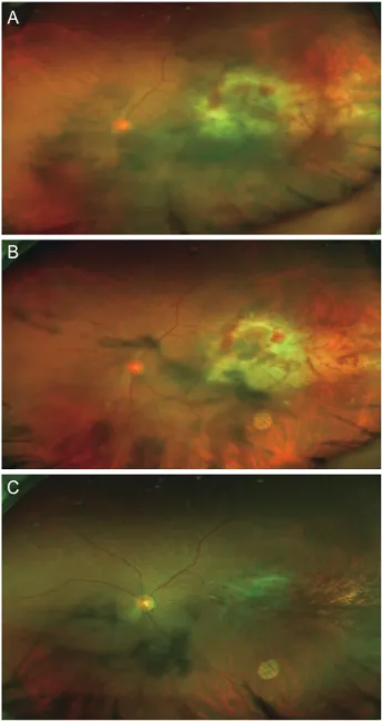 Figure 1. Representative image of patient 1. (A) Wide fundus pho- pho-tography of a 59-year-old man who visited the ophthalmology  clinic with a sudden decrease in vision in the left eye