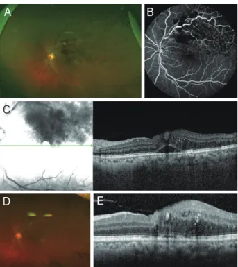 Figure 2. A representative case from the non-responder group. A  fifty-year-old man presented with visual discomfort in his left eye