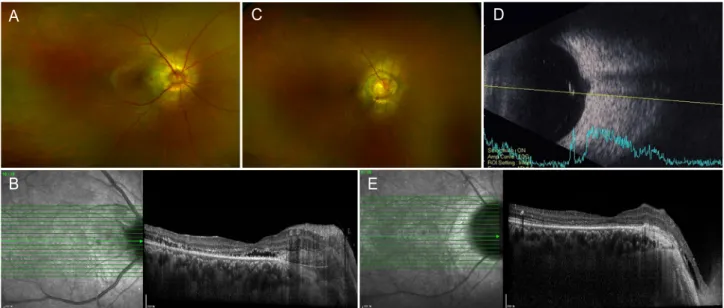 Figure 2. (A) The patient’s disc swelling and macular edema significantly improved 3 days after intravitreal dexamethasone implant injection in  a 50-year-old patient with diabetic papillopathy