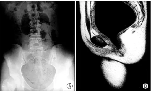Fig.  3.  (A)  Case5-Barium  enema  after  2  month  follow-up  with  conservative  treatment  reveals  the  dilated  rectosigmoid  colon,  (B)  Case  5-Barium  enema  6  month  after  surgical  resection  of  the  diliated  colon  showed  normal  colonic 