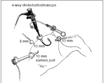 Fig.  1.  Four-port  technique  for  laparoscopic  CBD  exploration.
