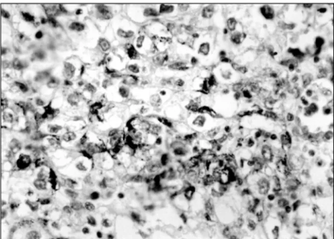 Fig.  4.  The  clear  tumor  cells  are  positive  for  epithelial  membrane  antigen