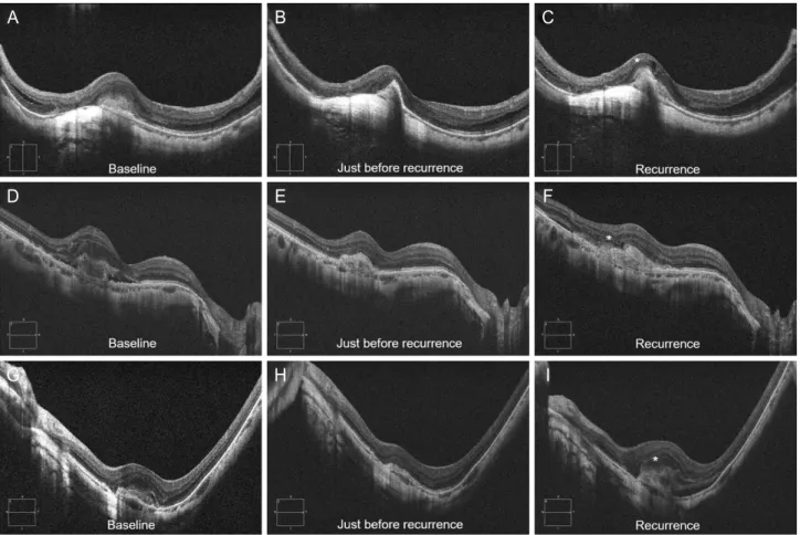 Table 4. A comparison of optical coherence tomography measurements and findings between PCV and myopic CNV patients at recurrence PCV (n = 43) Myopic CNV (n = 18) p-value