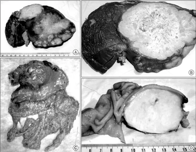 Fig.  6.  (A)  The  left  lobe  of  the  liver  contains  multiple  non-capsulated  necrotic  tumors