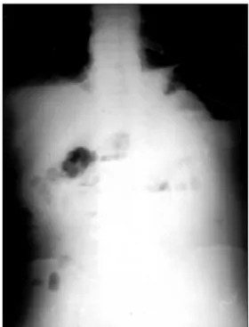 Fig.  1.  Plain  abdominal  film:  Marked  distended  small  bowel  loops  with  diffuse  haziness.