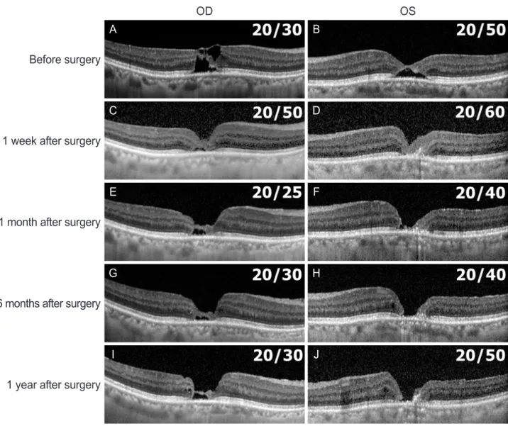 Figure 2. Optical coherence tomography (OCT) of a patient with macular telangiectasia treated with bilateral phacovitrectomy with internal lim- lim-iting membrane (ILM) peeling