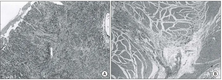 Fig.  5.  The  duodenum  shows  a  huge  geographic  tumor  mass,  measuring  4.5×3  cm  in  diameter