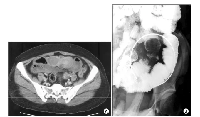 Fig.  2.  Operative  finding.  Jejuno-jejunal  intussusception  with  palp- palp-able  leading  point  was  found  during  laparotomy.