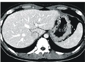 Fig.  1.  Preoperative  estimation  of  the  graft  liver  volume.  The  vol- vol-umes  of  left  lobe  (white  dotted  line)  and  caudate  lobe  (black  dotted  line)  were  measured  separately  using   com-puted  tomogram  volumetry