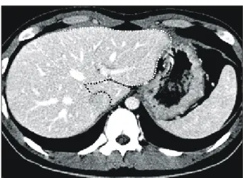 Fig.  1.  Preoperative  estimation  of  the  graft  liver  volume.  The  vol- vol-umes  of  left  lobe  (white  dotted  line)  and  caudate  lobe  (black  dotted  line)  were  measured  separately  using   com-puted  tomogram  volumetry