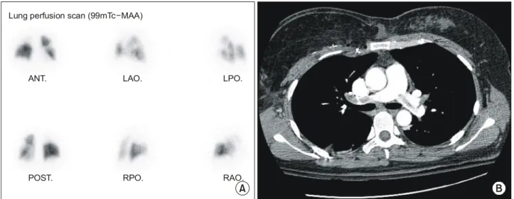 Fig.  1.  Pulmonary  thromboembilism  on  ventilation/perfusion  scan  and  lung  CT.  (A)  Large  V/Q  mismatched  lesion  was  noted  in  whole  right  upper  lobe  and  lingular  division  of  the  left  upper  lobe  on  ventilation/perfusion  scan  ima