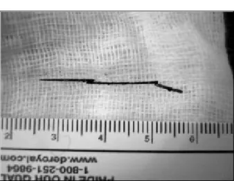 Fig.  3.  The  sewing  needle  after  retrieval.