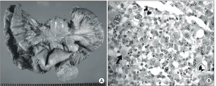 Fig.  2.  Abdomen  CT  scan  showed  with  dilatated  thickened  loop  of  small  bowel  wall,  “Target  sign”  (arrow).