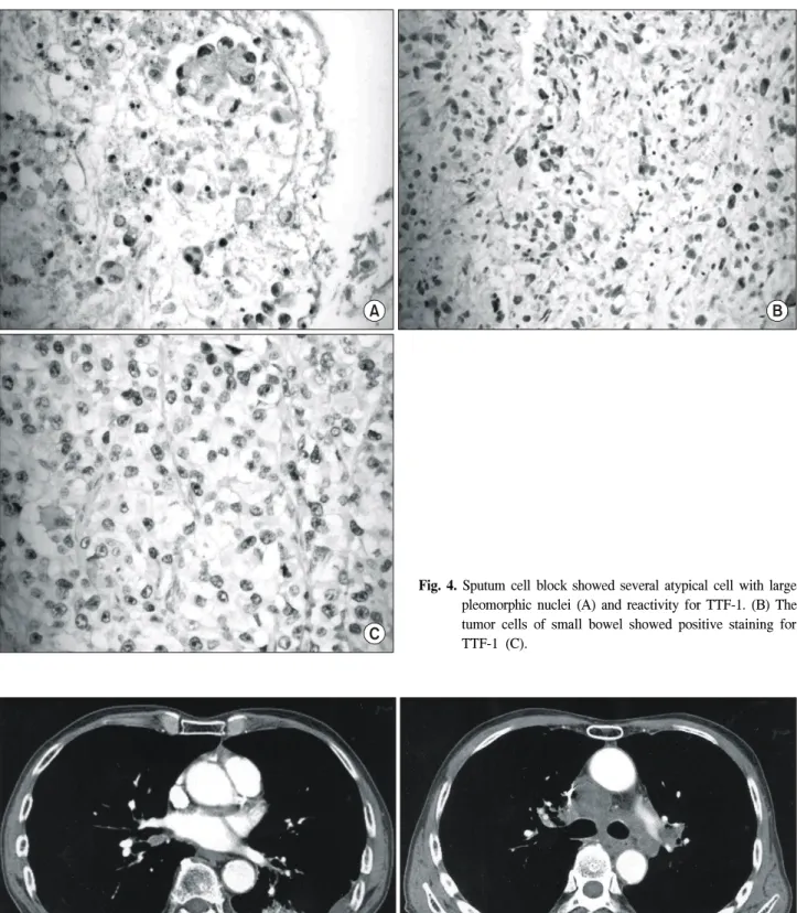 Fig.  5.  Chest  CT  scan.  There  were  a  air  space  consolidation  at  left  lower  lobe  (A)  and  enlarged  mediastinal  lymph  node  (B).