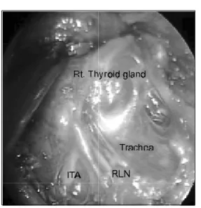 Fig.  2.  Anatomical  relationship  between  the  right  recurrent  laryn- laryn-geal  nerve  (RLN)  and  the  inferior  thyroid  artery  (ITA).