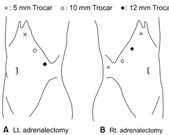 Fig.  1.  Trocar  sites  for  laparoscopic  adrenalectomy.