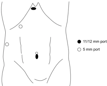 Fig.  1.  Site  and  size  of  the  Trocars  for  the  laparoscopic  excision  of  choledochal  cyst.