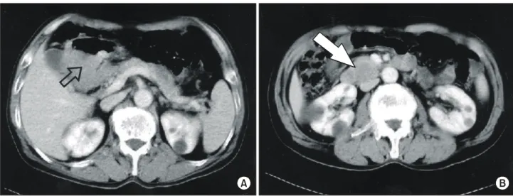 Fig.  2.  The  cut  surface  of  the  primary  tumor  of  the  stomach  showed  an  ulcerofungating,  huge  tumor  with   exo-phytic  growth  to  be  present  in  the  gastric  antrum.