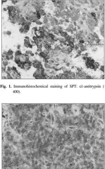 Fig.  2.  Immunohistochemical  staining  of  SPT:  neuron    specific  en- en-olase  (×400).