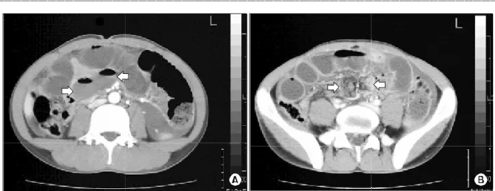 Fig.  2.  A  giant  Meckel's  diverticulum  with  torsioned  base  and  gangrenous  change.