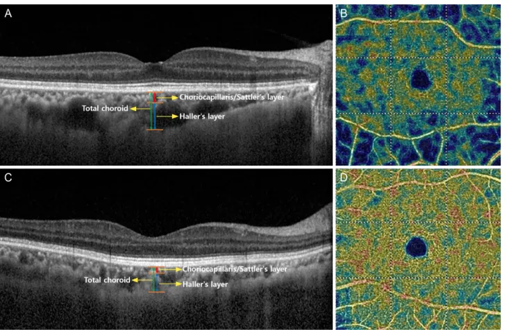 Figure 1. Optical coherence tomography (OCT) (A, C), and OCT angiography (B, D) findings of a fellow eye with a branch retinal vein  occlusion (BRVO) (A, B) and normal eye (C, D)