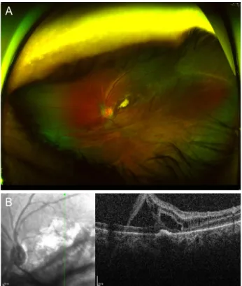 Figure 2. (A) Wide-angle fundus photography and (B) optical co- co-herence tomography of the left eye approximately 8 months after  the patient’s initial visit.