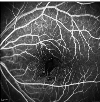 Figure 1. Example of fluorescein angiography show broken peri- peri-foveal capillary network with capillary nonperfusion area which is  involved two quadrants within 1 disc diameter of fovea center.