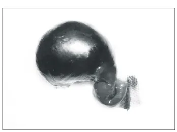 Fig.  2.  Resected  Meckel's  diverticulum.