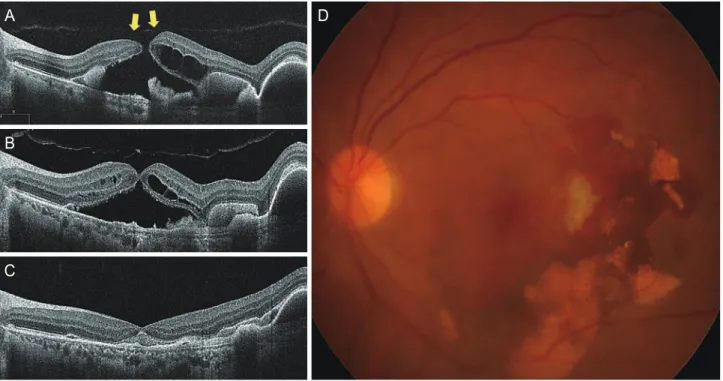 Figure 2. (A) A full-thickness macular hole is observed six weeks after initial intravitreal aflibercept treatment