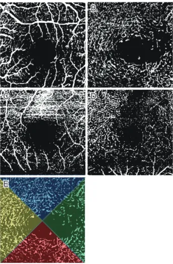 Table 1. Baseline clinical features of patients diagnosed with idio- idio-pathic MacTel 2 and macular BRVO