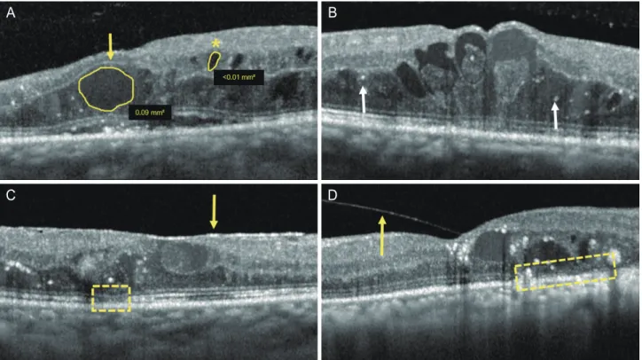 Figure 1. Optical coherence tomography measures. (A) Grading of intraretinal cysts: outer nuclear layer (ONL) cyst (yellow arrow) and inner nu- nu-clear layer (INL) cyst (*) (small, <0.1 mm 2 ; large, 0.1-0.2 mm 2 ; giant, >0.2 mm 2 )
