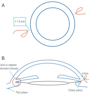 Figure 1. Flowchart of the patient enrollment process. We reviewed  116 eyes who received intraocular lens (IOL) trans-scleral ciliary sulcus  fixation using a single IOL by a single surgeon