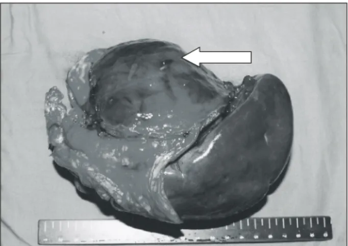 Fig.  4.  The  tumor  cell  type  of  the  lymph  node  metastasis  was  squamous  cell  carcinoma  (H&amp;E,  ×200).