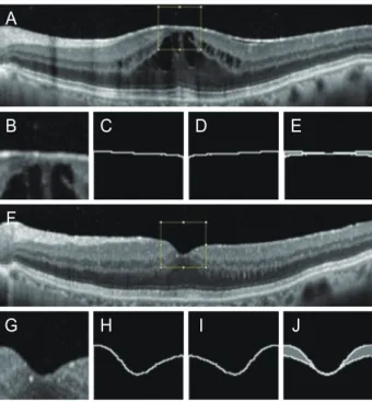 Figure 1. Binary processing of the fovea and Analysis of the foveal  surface symmetry difference (FSSD)
