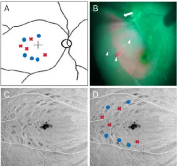 Figure 2. En-face image 2 months after surgery. (A) Inner retinal  dimple is confirmed